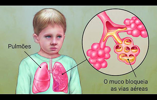 Gene responsável pela Fibrose Cística