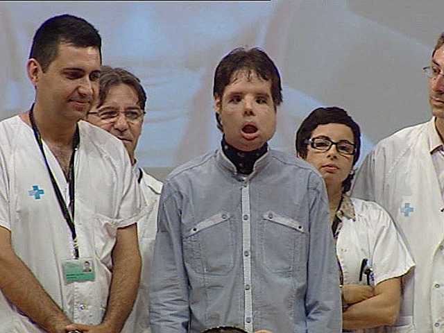 Primer trasplante de cara