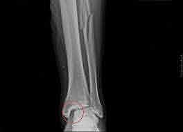 me rompi la tíbia i el peroné