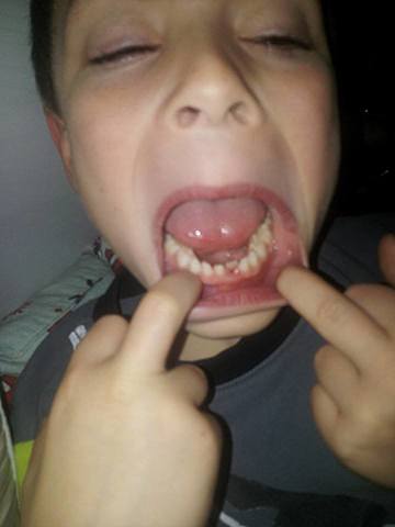 Chute de ma première dent