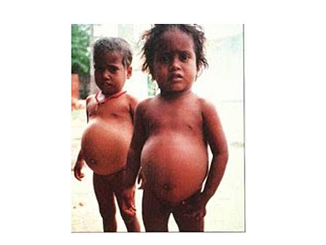 Aparición del Kwashiorkor
