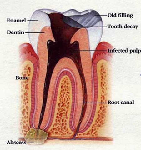 First Root Canal