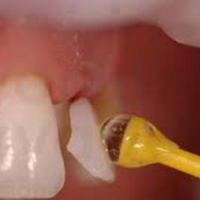 Timeline: Proceso de adhesion