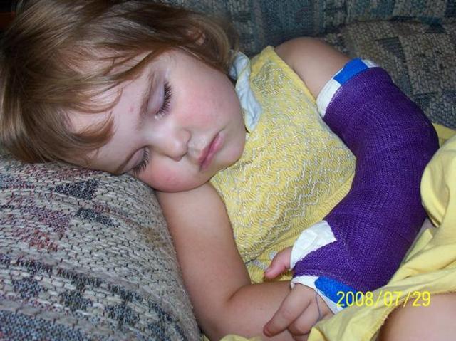 Broke my right elbow.