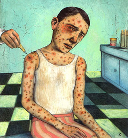 Small Pox Introduced