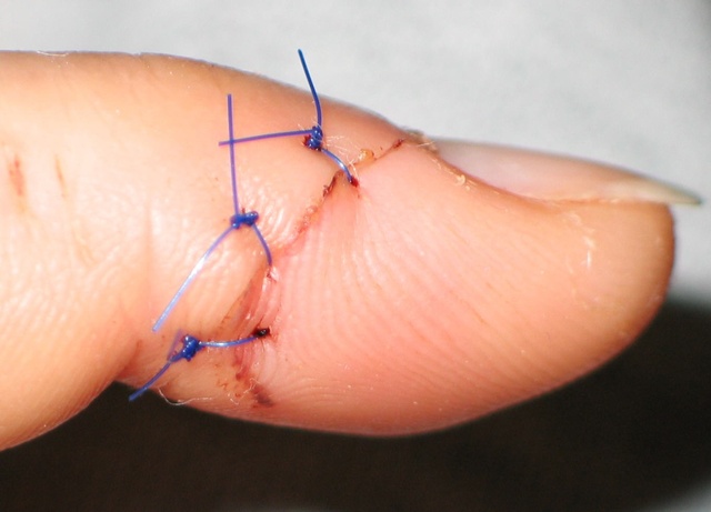 Stitches in my finger