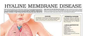 Son was diognost with Hyaline membrane disease