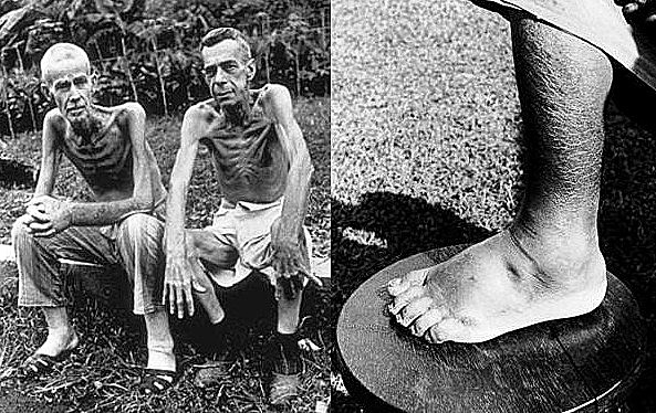 Prevención de la enfermedad Beriberi