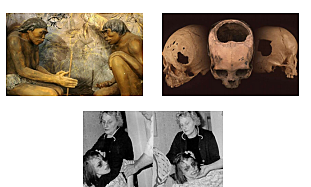 Trepanación