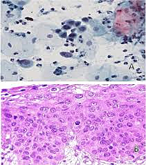 Cambios en células escamosas