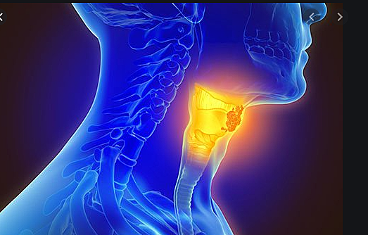 Pharyngeal cancer treatment