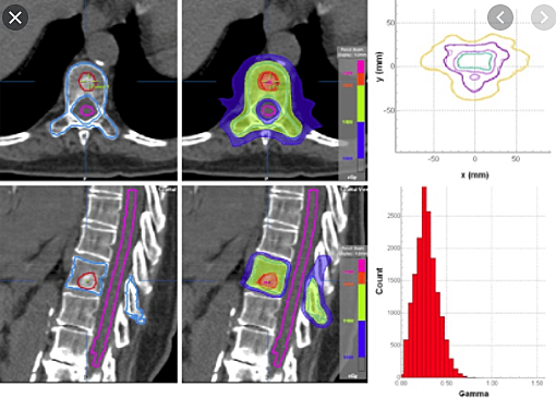 SBRT to prevent extracranial tumors