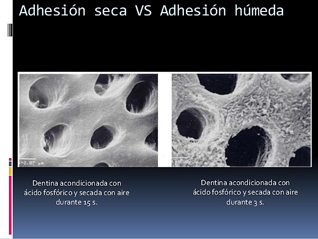 Acondicionamiento de dentina