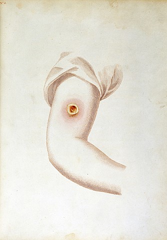 Sviluppo della Variolizzazione