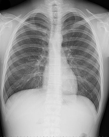 Mejorando la radiografía torácica