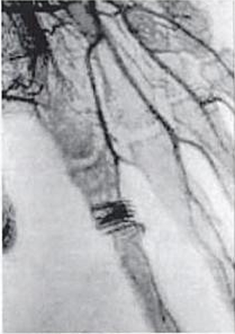 Contraste intravascular