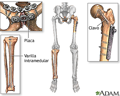 Implementación de placas de acero