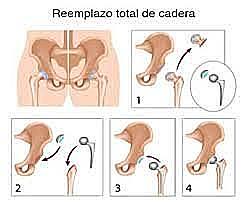 Primer reemplazo total de cadera