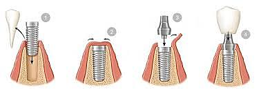 Implantes de teﬂón