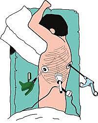 Primeras Toracoscopias