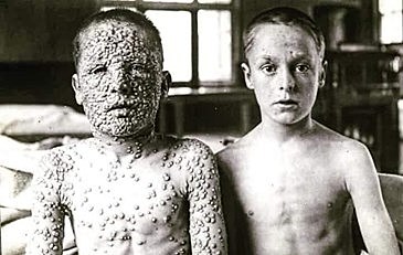 SMALLPOX