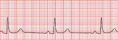 Bradycardia