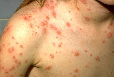 Smallpox