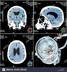1975 Tomografía axial