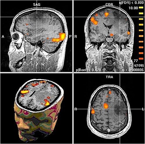 Años 90 Tomografía (PET) y resonancia (FMRI)