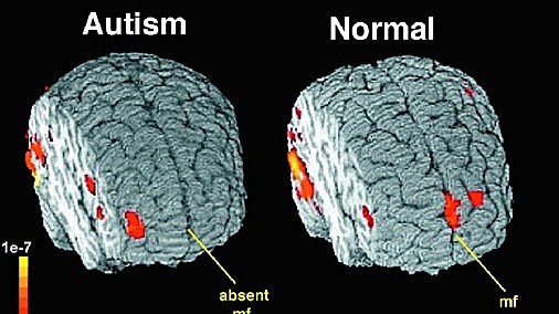 Siglo XXI El autismo