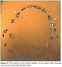 Bite Mark analysis is first used in court
