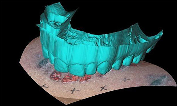 Bite mark analysis accuracy
