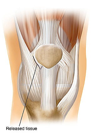 Patella Realignment Surgery on Right Knee