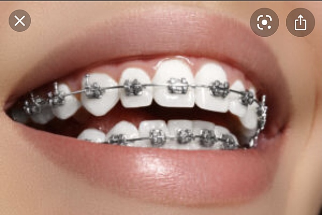 When I got my braces on