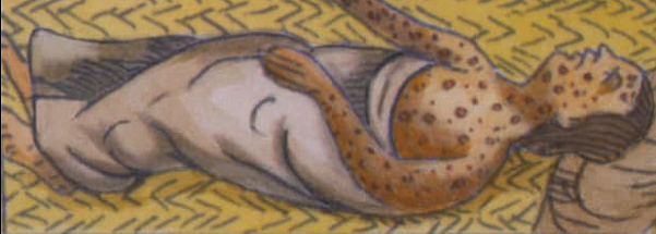 Smallpox Kills Native Americans