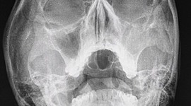 Timeline: Historia de los Rayos X