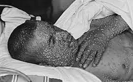 Smallpox Epidemic