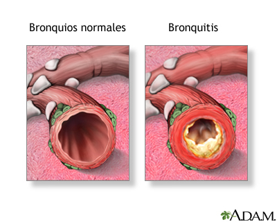 A bronquitis