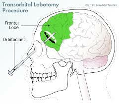 Labotomies began