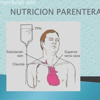 Timeline: Nutrición Parenteral