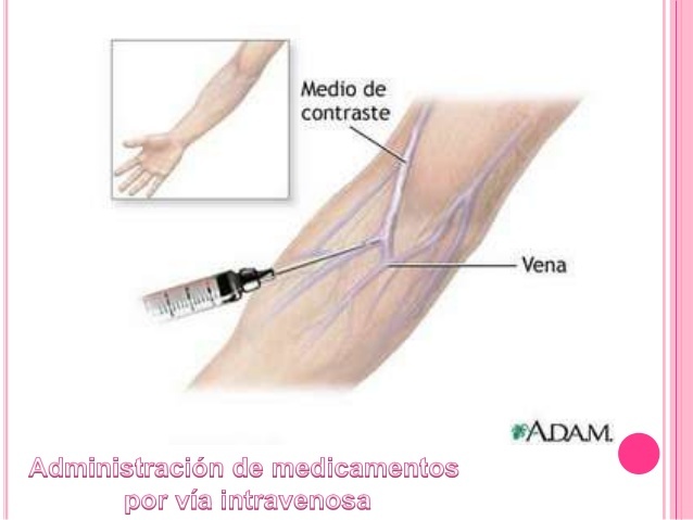 Método de administración de medicamentos por vía intravenosa.
