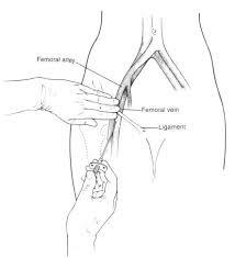 Primera cateterización de la vena cava inferior por vía femoral.
