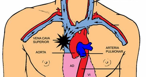 Utilización de la vena cava superior