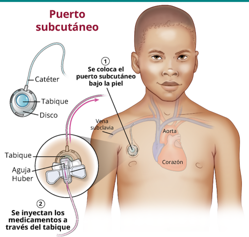 Primer puerto subcutáneo.
