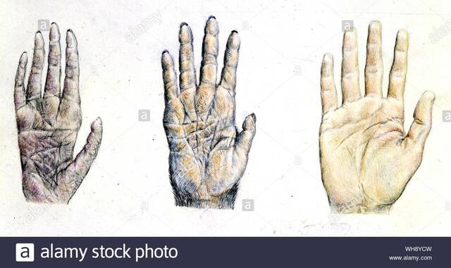 El Dr. William Babler de la Universidad de Marquette en Milwaukee, WI, publicó “Embryological Development of Epidermal Ridges and Their Configurations”