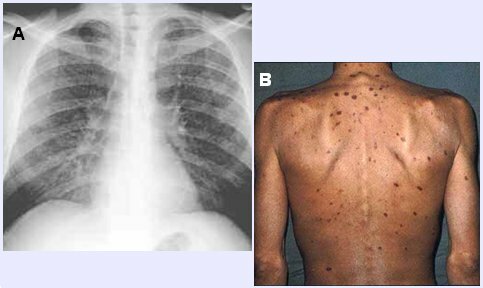 Aparece una nueva  Neumonía
