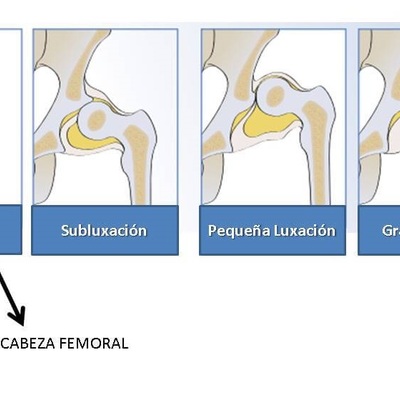 Timeline: CIRUGIA DE CADERA ESPASTICA EN NIÑOS