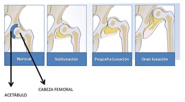 Timeline: CIRUGIA DE CADERA ESPASTICA EN NIÑOS