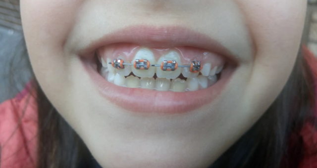Em posen brackets