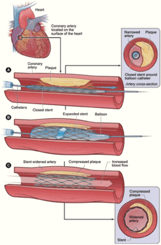 Angioplastia transluminal percutánea: Charles Dotter